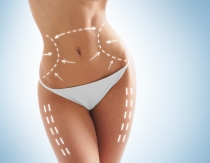 Remodelage Corporel : Traiter Graisse, Cellulite, Relâchement à Colmar