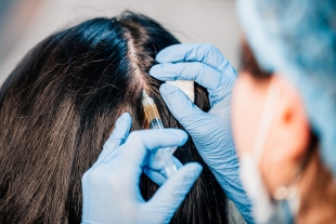 Injections de PRP à Colmar : Traitement Alopécie, Repousse Cheveux